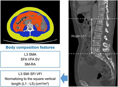 Preoperative computed tomography-determined sarcopenia is a reliable prognostic factor in patients with gastric cancer after radical gastrectomy: A sex-specific analysis